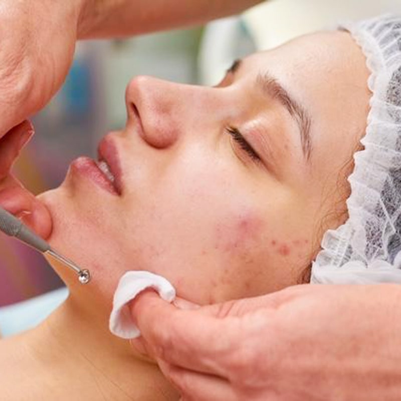 Acne Treatment 5 Sessions